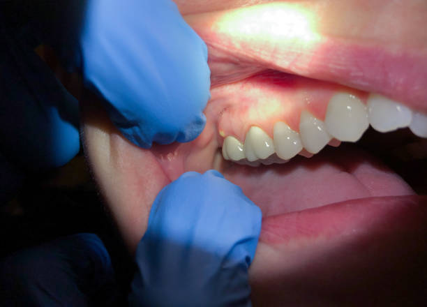Best Dental Abscess Treatment in Bowling Green, OH